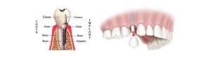 implant dentistry 1 image on Huntingdon Valley Dental Arts