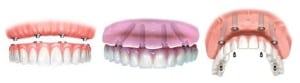implant dentistry 2 image on Huntingdon Valley Dental Arts