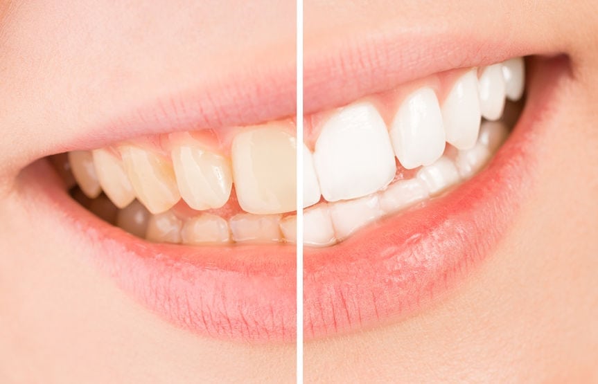 Common Dental Myths