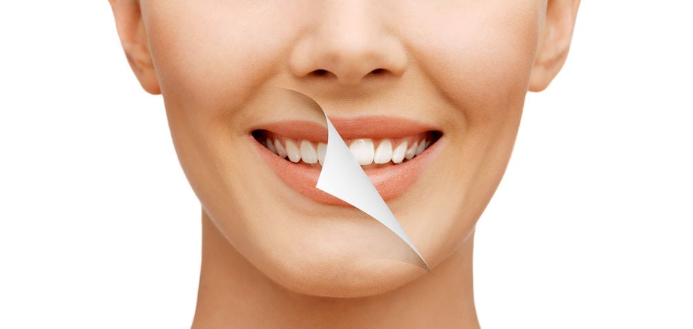 Three Things to Know Before Whitening Your Teeth