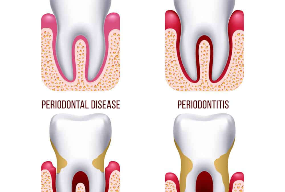 The Causes of Periodontal Disease