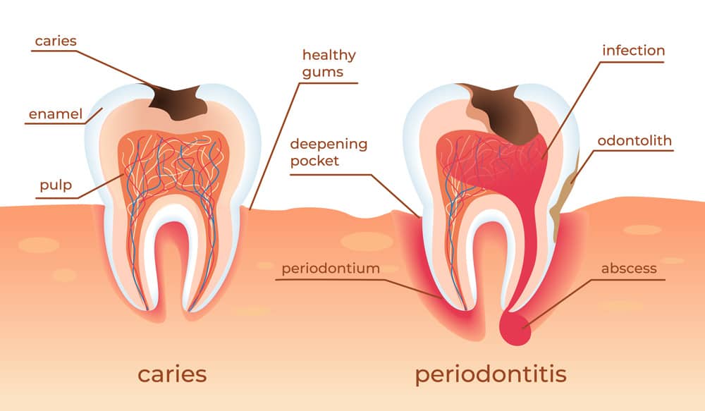What is Periodontal Disease