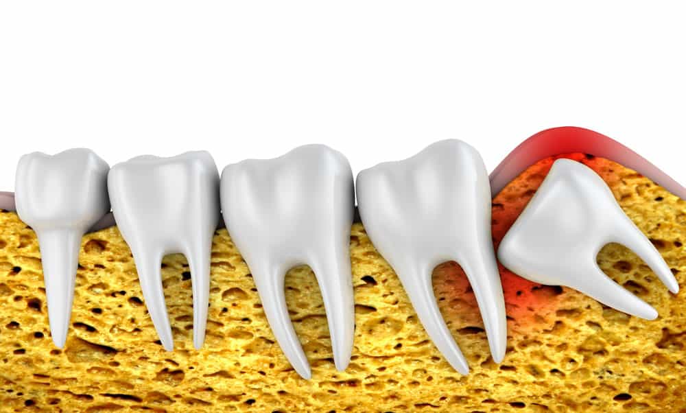 Do I Need to Have My Wisdom Teeth Removed?