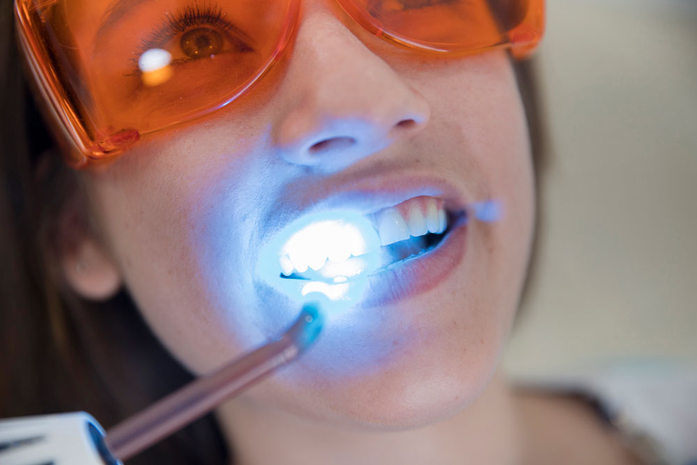 Over the Counter Teeth Whitening vs. Professional Whitening